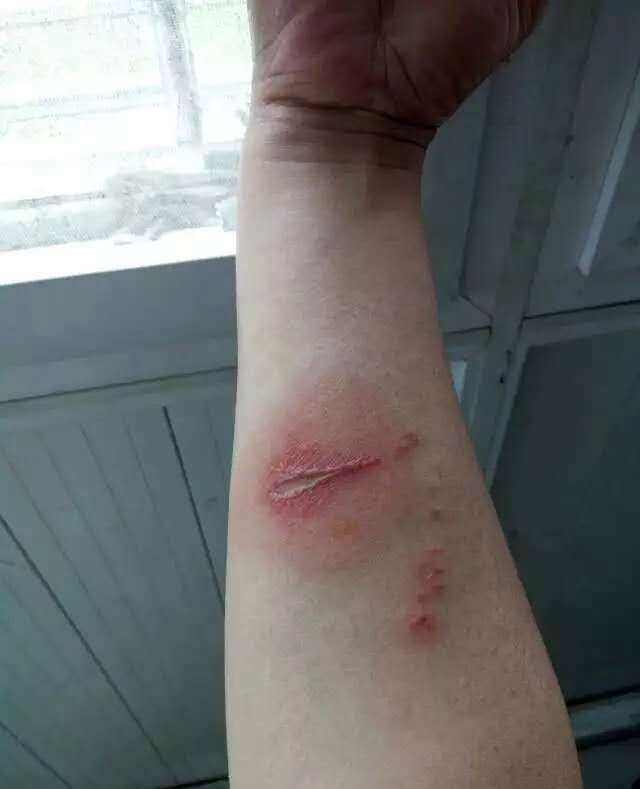 我被这种常见的隐翅虫咬了一口,结果这块